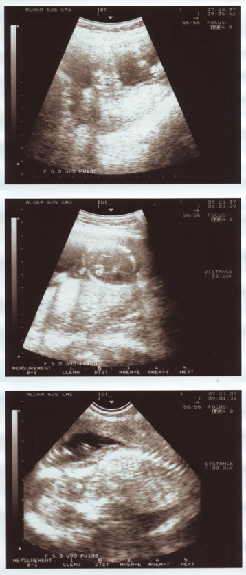 ultra sound 15 weeks pregnant