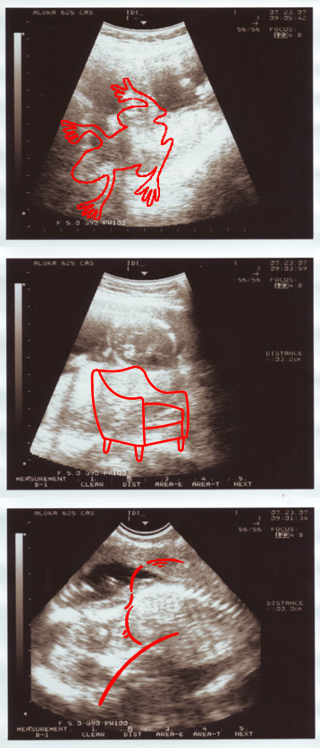 ultra sound 15 weeks pregnant annotated