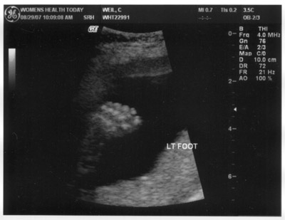 ultra sound foot