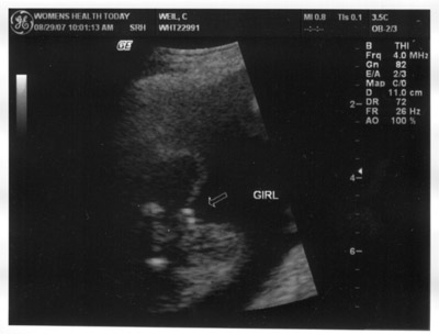 ultra sound image of baby girl genitals